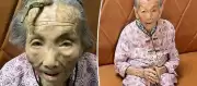 107 yaşındaki bir kadının kafasında nadir rastlanan boynuz oluşumu, tıp camiasını şaşırttı.